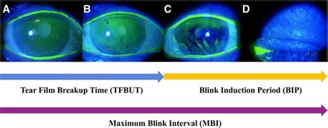 tear breakup time test procedure|invasive tear break up time.